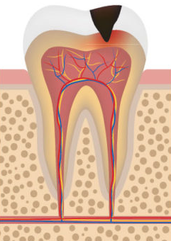 stage 3 decay