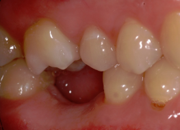 dental examination implant