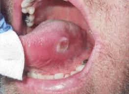 oral cancer