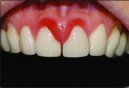 scale and clean bleeding gums