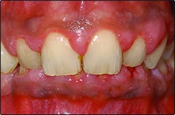 gingivitis scale and clean