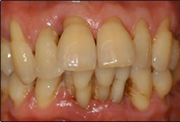 scale and clean teeth