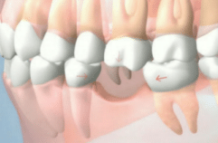 3 drifting teeth