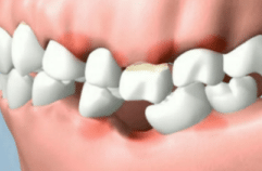 6 severe drift over-eruption bone loss