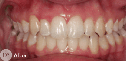 Invisalign after