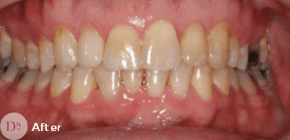 Invisalign after